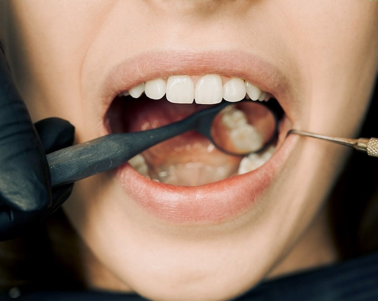 5 Common Signs That You Might Need A Tooth Extraction