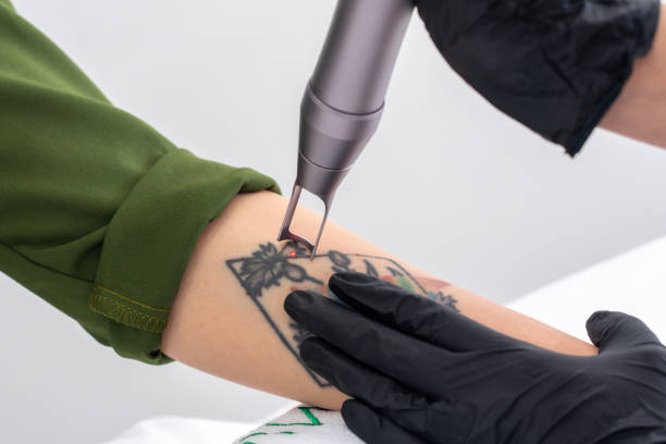 Tattoo Removal in the UK: Everything You Need to Know