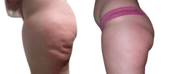 Cellulite Reduction