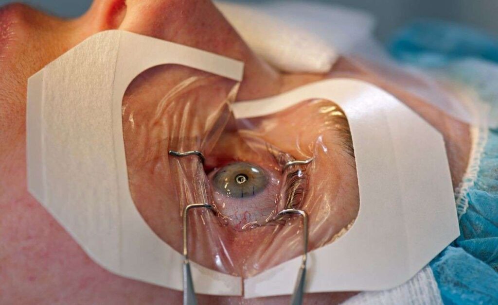 LASIK in Australia