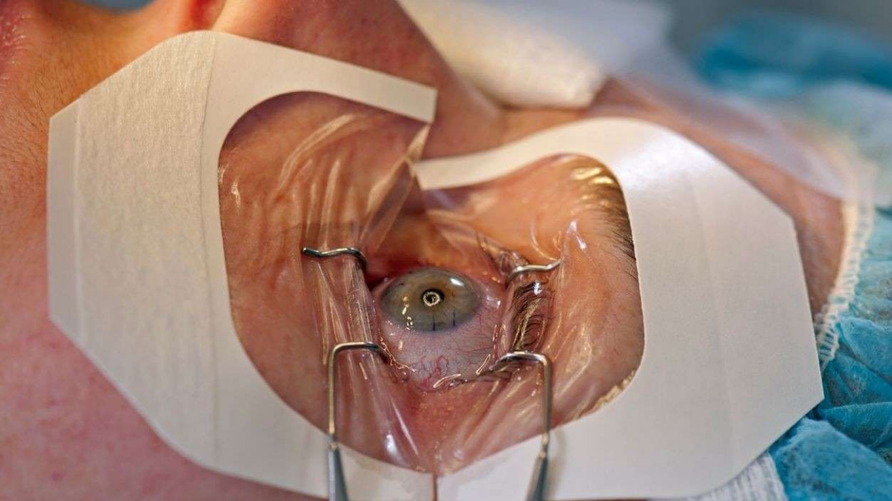 LASIK Eye Surgery
