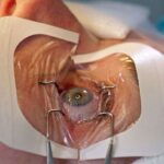 LASIK for Astigmatism: Can Modern Tech Fix Blurred Vision?